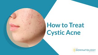 How to Treat Cystic Acne