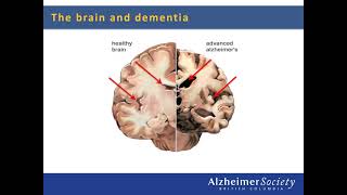 Dementia education I An introduction to brain health