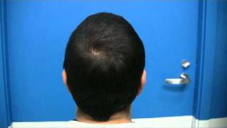 Hair Transplant in Canada ( 4981 Grafts - Dr Hasson )