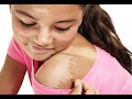 How to Get Rid of Peeling Skin after Sunburn - Sunburn Treatment How to Get Rid of Peeling Skin after Sunburn - Sunburn Treatment
