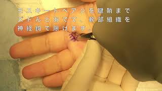 【ばね指】リアル手術動画/腱鞘切開術