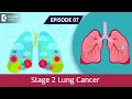 Stage 2 Lung Cancer Symptoms, Treatment. Life Expectancy | Dr Sandeep Nayak & Dr. Sreekanth Reddy