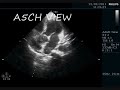 dissection of aorta echocardiography series by dr ankur k chaudhari.