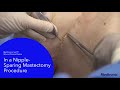 The V-Loc™ Wound Closure Device in a nipple-sparing mastectomy procedure