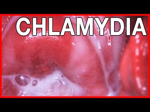 Thought differently, chlamydia thrush opinion you Chlamydia thrush final, sorry