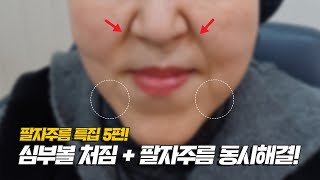 팔자주름 특집 5편!) 심부볼 처짐 + 팔자주름 동시해결 방법!