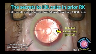 CataractCoach™ 2389: the secrets IOL calcs prior RK radial keratotomy