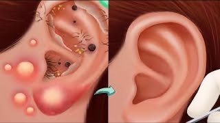 Itchy & Smelly Ear Stone Removal! Digging Out Super Big Earwax | ASMR Animation | Meng's Stop Motion