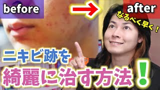 【美肌】ニキビ跡、シミを少しでも早くケアする方法！やっぱりこれだった！