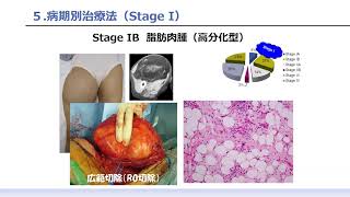 肉腫～総論～　川井章　～主に医療者向け～ 【国立がん研究センター希少がんセンター】