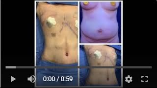 HIGH DEFINITION TUMMY TUCK