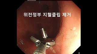 위내시경 위전정부 지혈 클립 제거 The process of removing a hemostatic clip using endoscopy.