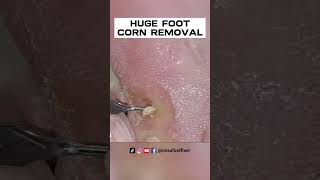 HUGE FOOT CORN REMOVAL