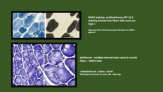 Neurology Quiz #77  Core myopathies