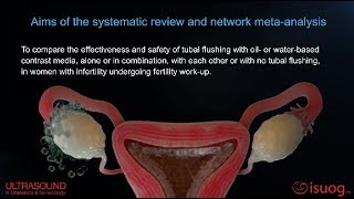 UOG video abstract on tubal flushing