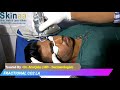 Fractional CO2 Laser Treatment for Acne Scar in Jaipur, India – Dr Atul Jain