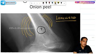 Ewing's Sarcoma (Hindi) : Orthopedics Lecture