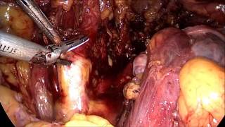 Laparoscopic PLND