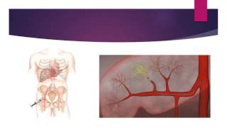 Selective Internal Radiation Therapy with Spheres Microspheres