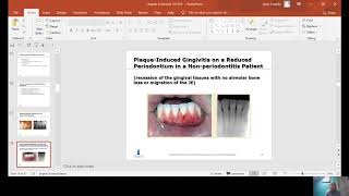 Chapter 6 Periodontal Health, Gingival Diseases and Conditions