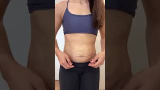 Antes e depois pós 7 dias de abdominoplastia (remoção de sobra de pele + correção de diástase)