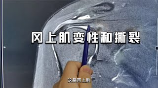 肩關節核磁系列（一）：岡上肌變性和撕裂如何看？