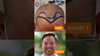 Hair Transplant Results - 12 Month Time-lapse Before and After #shorts