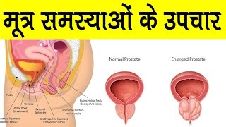 Treatment of Prostate Enlargement  & Urine Problems -  Rajiv Dixit