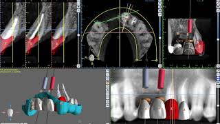 Planificación digital de Implantes Dentales - Munt Espai Dental