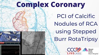 Watch Live PCI of Calcific Nodules of RCA using Stepped Burr RotaTripsy