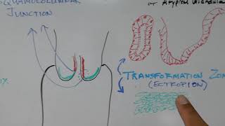 UTERINE CERVIX PATHOLOGY - Atypical Endocervix \u0026 Atypical Glandular Cells