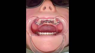 How to Complete an Incomplete/ Stuck Expander Turn- Pediatric Dentistry & Family Orthodontics