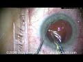 cataractcoach 1608 different ways to explant iols iol exchange