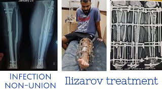 tibia fibula bone fracture infection and non-union kolkata se ilaj ke liye bharatpur aaya