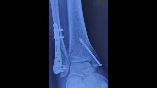 Ankle Fractures - \