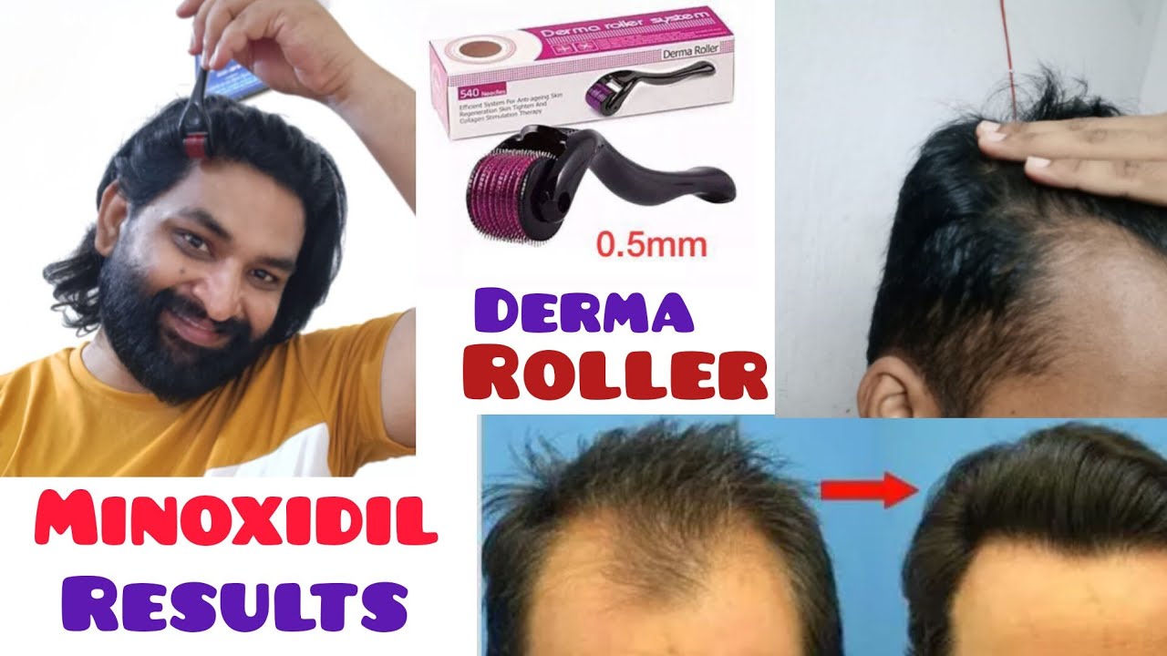 Derma Roller For Hair Growth | How To Use Derma Roller On Hairline ...