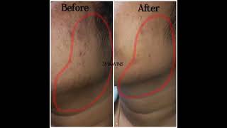 Tan skin or pigmented skin try our detan treatment @smaavins #vadapalani #cosmetic #call; 9962234451