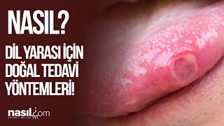 DİL YARASI NASIL GEÇER? NE İYİ GELİR? İŞTE DOĞAL ÇÖZÜMLER! #dil #yara #sağlık #doğal #tedavi