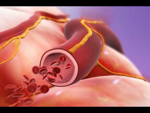 How do you stop basilar migraines?