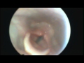 Vocal cord dysfunction NOS