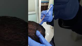 PRP For Hair Loss Treatment -  (Platelet Rich Plasma)                          Dr. Vivek Rungta