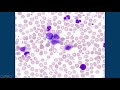 chronic myeloid leukemia cml peripheral blood smear hematopathology u0026 hematology