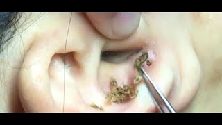 Could it Happen to Me?: Ear Blackheads