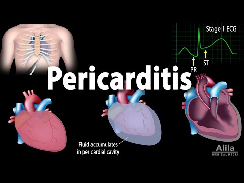 What can make pericarditis worse?