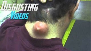 THE PIMPLE POP SUPER BOWL 2017! PIMPLES AND BLACKHEADS HD