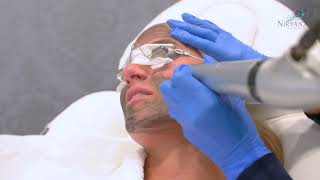 Biznct - Carbon Facial - Medical Spa Marketing - Digital \u0026 Video Marketing