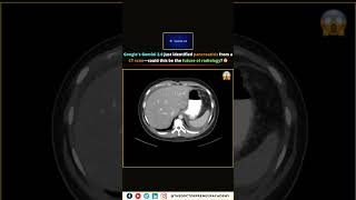 Google Gemini 2.0 Diagnoses Pancreatitis from CT Scan – The Future of Radiology? 🤖🩺