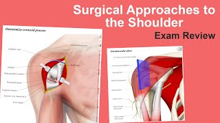 Surgical Approaches to Shoulder Exam Review - William N. Levine, MD