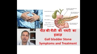 Gall bladder stone symptoms treatment in Hindi By Dr Vikas Singla