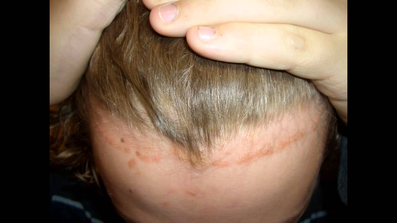 Dr Kin Leung Naturopathic Case Review Patient With Psoriasis Vulgaris